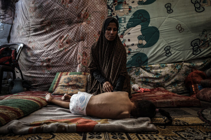 The number of children suffering from malnutrition due to hunger in Gaza is increasing